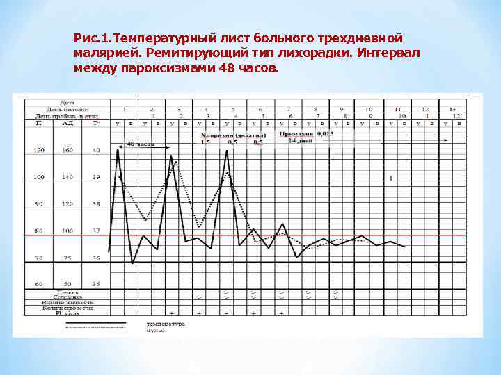 Рис. 1. Температурный лист больного трехдневной малярией. Ремитирующий тип лихорадки. Интервал между пароксизмами 48