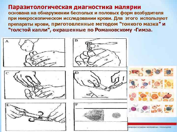 Паразитологическая диагностика малярии основана на обнаружении бесполых и половых форм возбудителя при микроскопическом исследовании