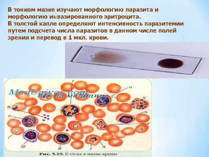 В тонком мазке изучают морфологию паразита и ). морфологию инвазированного эритроцита. В толстой капле