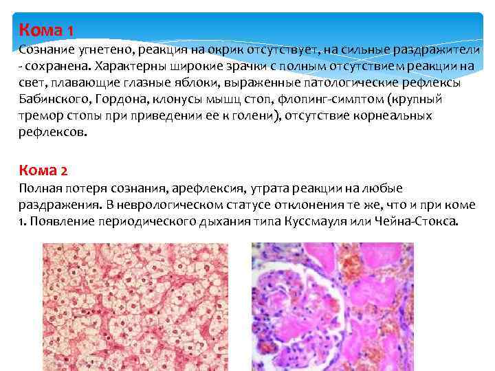 Кома 1 Сознание угнетено, реакция на окрик отсутствует, на сильные раздражители сохранена. Характерны широкие