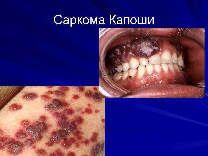 Саркома Капоши 