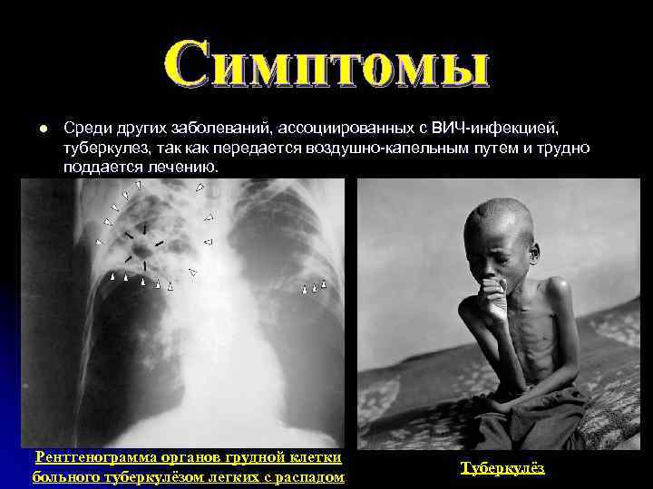 Симптомы l Среди других заболеваний, ассоциированных с ВИЧ-инфекцией, туберкулез, так как передается воздушно-капельным путем