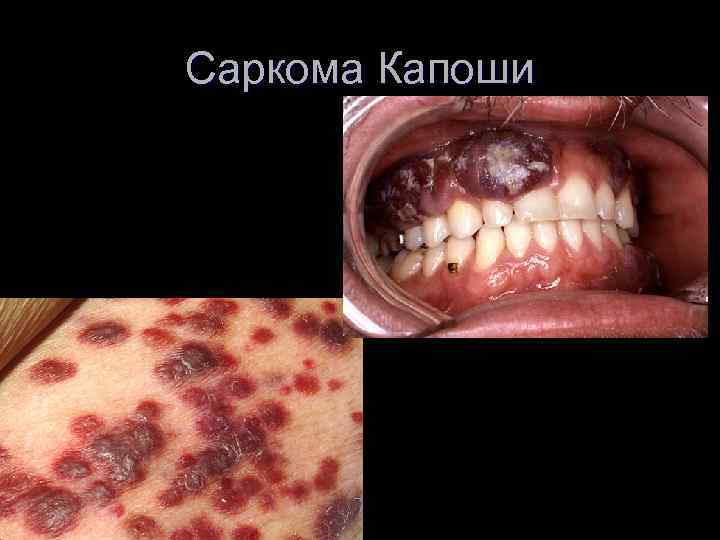 Саркома Капоши 