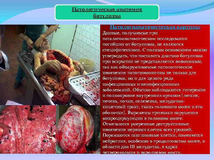 Патологическая анатомия ботулизма Патологоанатомическая картина: Данные, получаемые при паталогоанатомическом исследовании погибших от ботулизма, не