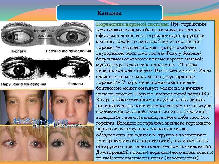 Клиника Поражение нервной системы: При поражении всех нервов глазных яблок развивается полная офтальмоплегия, если