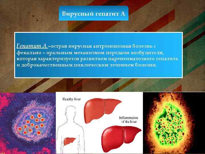 Вирусный гепатит А Гепатит А –острая вирусная антропонозная болезнь с фекально – оральным механизмом