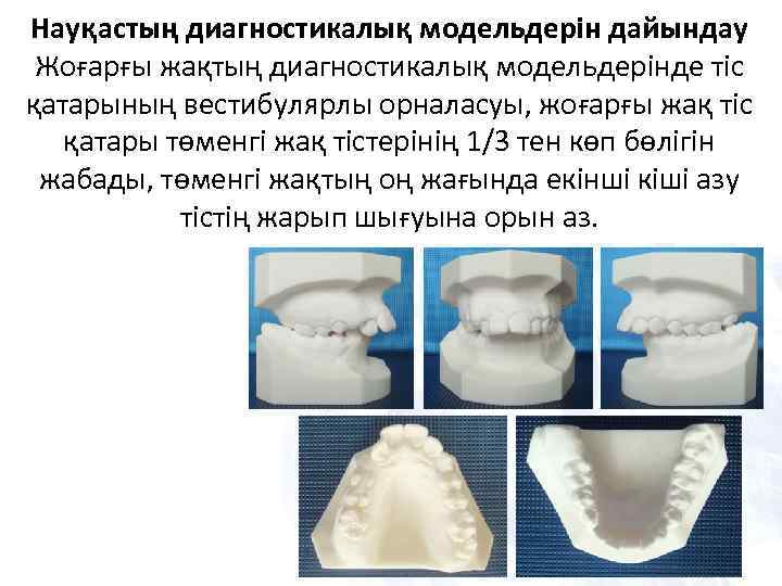 Науқастың диагностикалық модельдерін дайындау Жоғарғы жақтың диагностикалық модельдерінде тіс қатарының вестибулярлы орналасуы, жоғарғы жақ