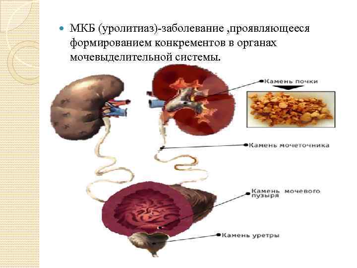  МКБ (уролитиаз)-заболевание , проявляющееся формированием конкрементов в органах мочевыделительной системы. 