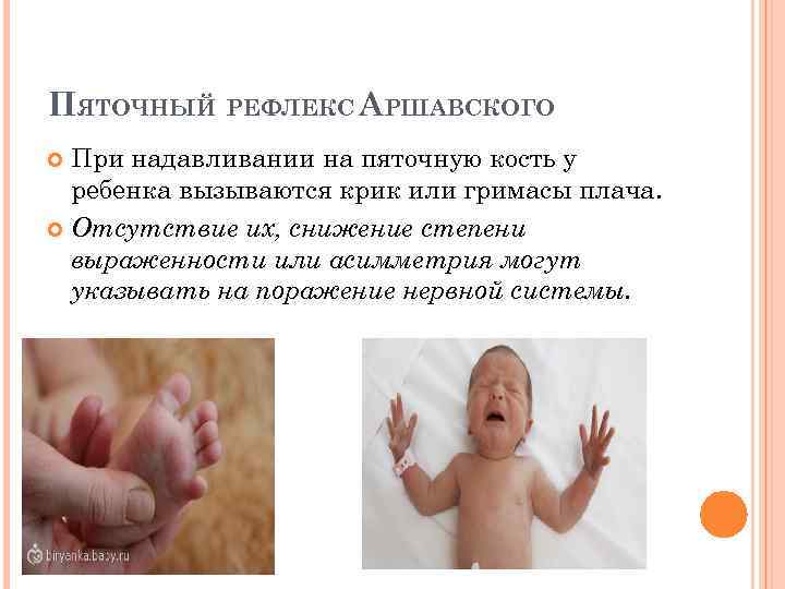 ПЯТОЧНЫЙ РЕФЛЕКС АРШАВСКОГО При надавливании на пяточную кость у ребенка вызываются крик или гримасы