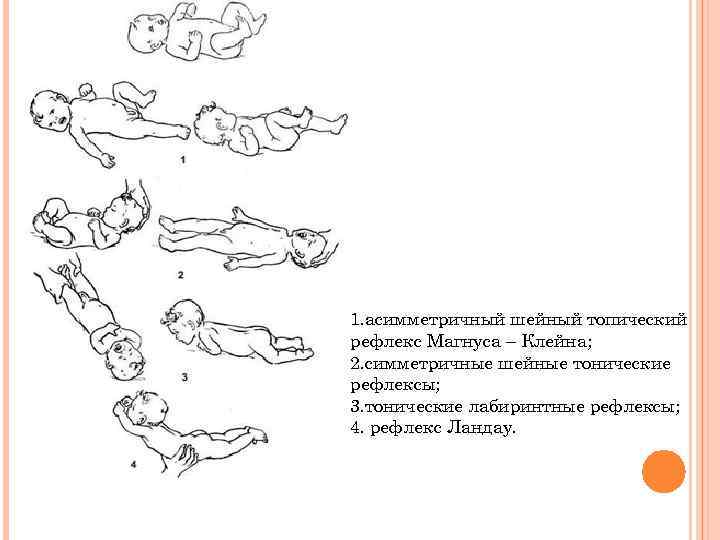 1. асимметричный шейный топический рефлекс Магнуса – Клейна; 2. симметричные шейные тонические рефлексы; 3.