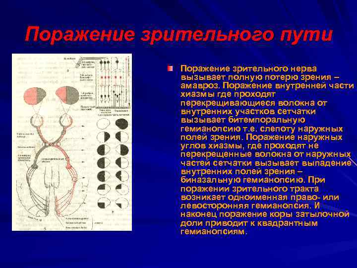 Поражение зрительного пути Поражение зрительного нерва вызывает полную потерю зрения – амавроз. Поражение внутренней