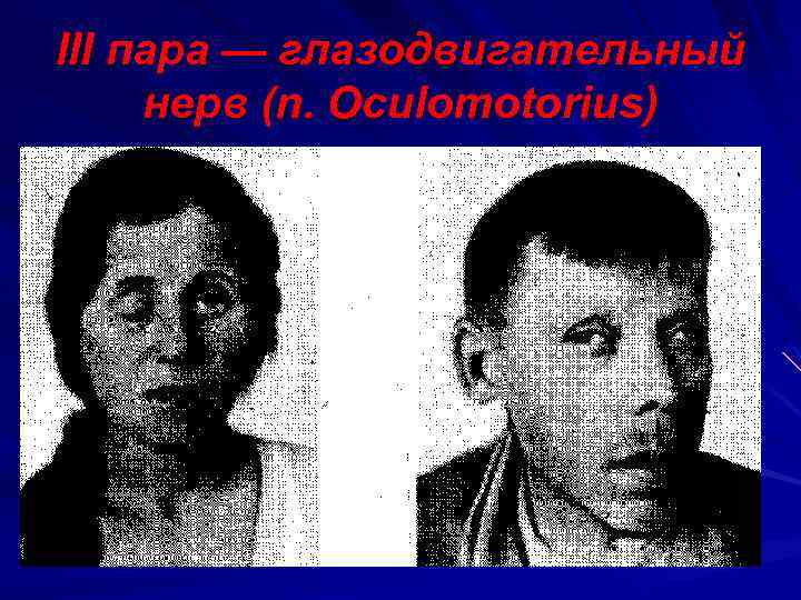 III пара — глазодвигательный нерв (n. Оculomotorius) 