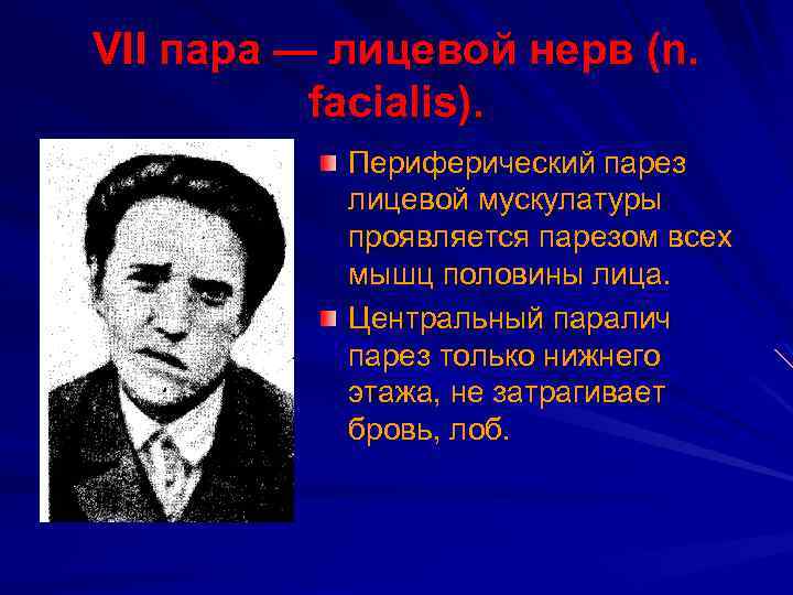VII пара — лицевой нерв (n. facialis). Периферический парез лицевой мускулатуры проявляется парезом всех