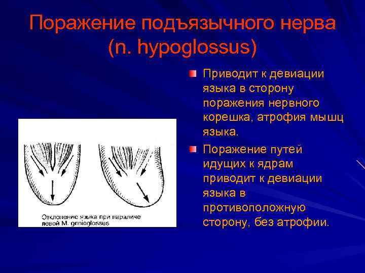 Поражение подъязычного нерва (n. hypoglossus) Приводит к девиации языка в сторону поражения нервного корешка,