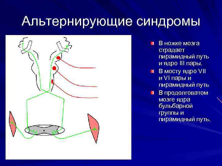 Альтернирующие синдромы В ножке мозга страдает пирамидный путь и ядро III пары. В мосту