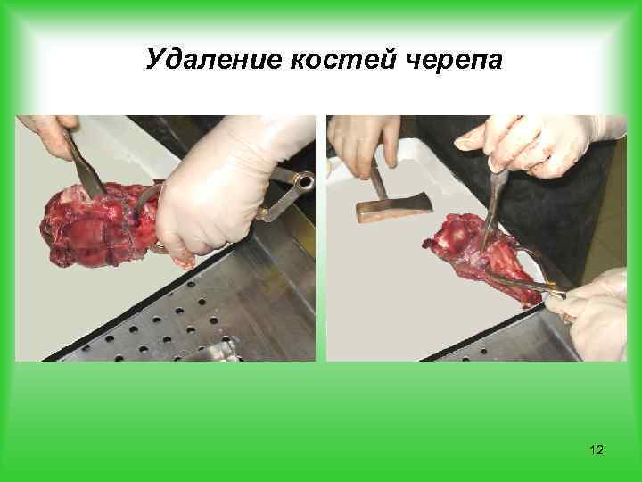 Удаление костей черепа 12 