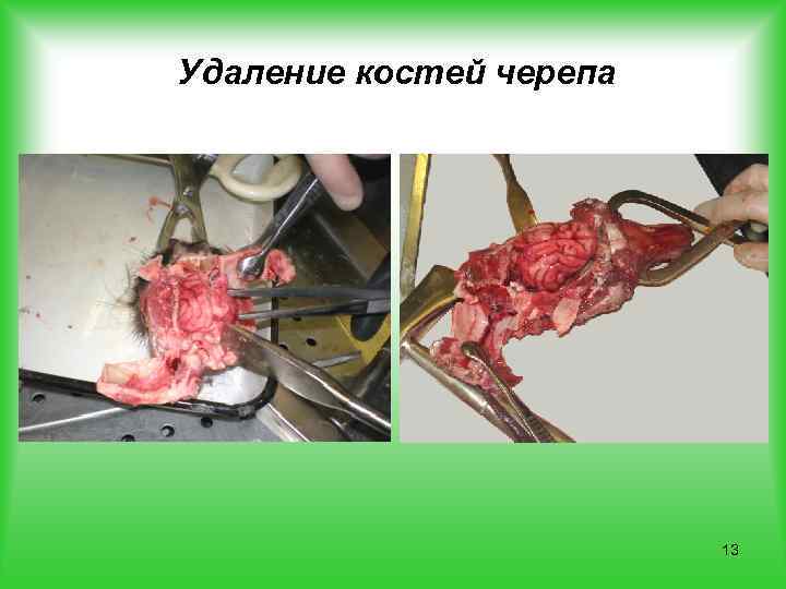 Удаление костей черепа 13 