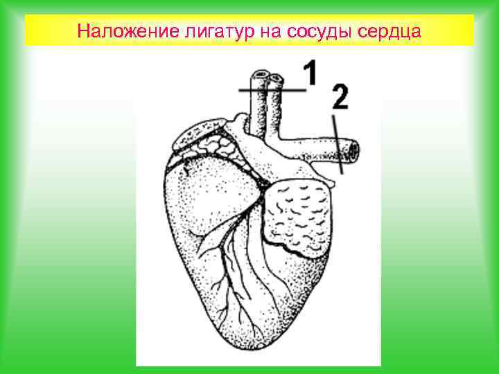 Наложение лигатур на сосуды сердца 