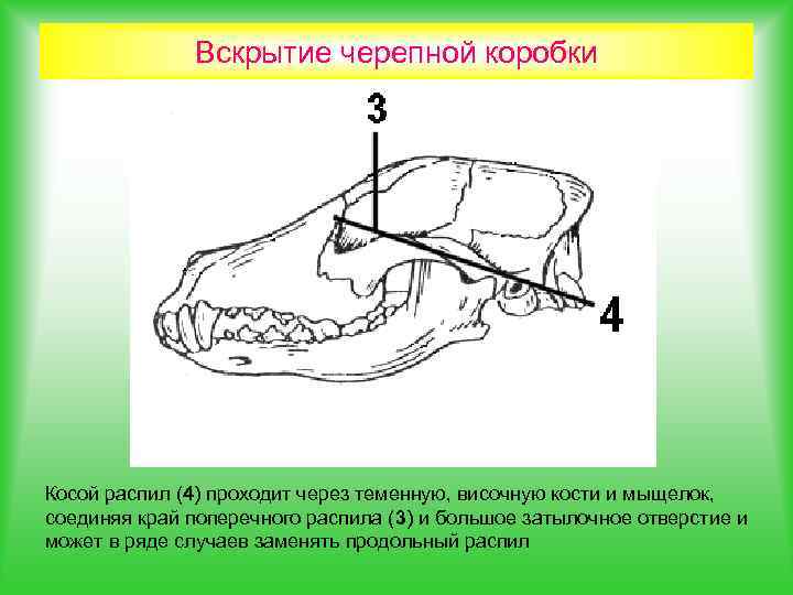 Вскрытие черепной коробки Косой распил (4) проходит через теменную, височную кости и мыщелок, соединяя