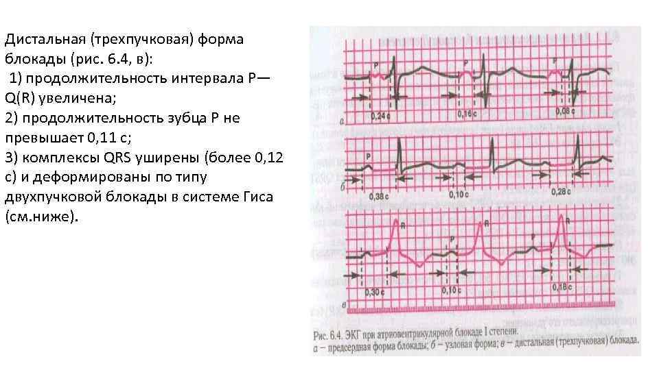 Полная ав блокада карта вызова