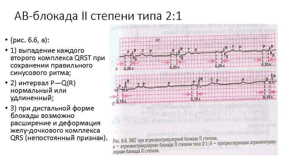 Ав блокада 1 степени. АВ блокада 2 степени Мобитц 3. ЭКГ при АВ блокаде 2 степени. АВ блокада 2 ст Мобитц 1 на ЭКГ. Атриовентрикулярная блокада 2 степени 1 Тип ЭКГ.