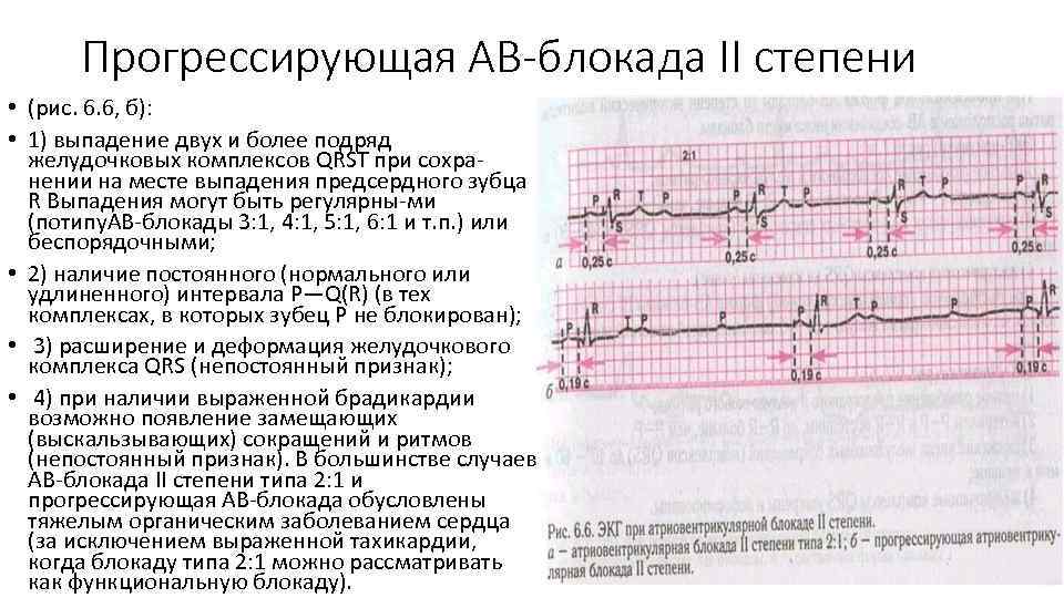 Ав блокада 2 степени