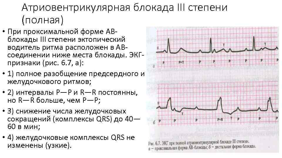Блокада сердца опасно для жизни. ЭКГ признаки полной атриовентрикулярной блокады. АВ блокада 2 степени Мобитц 1 на ЭКГ. Степени атриовентрикулярной блокады на ЭКГ. АВ блокада 1 степени на ЭКГ.