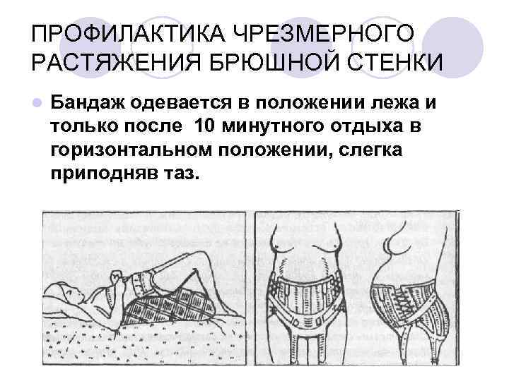 ПРОФИЛАКТИКА ЧРЕЗМЕРНОГО РАСТЯЖЕНИЯ БРЮШНОЙ СТЕНКИ Бандаж одевается в положении лежа и только после 10