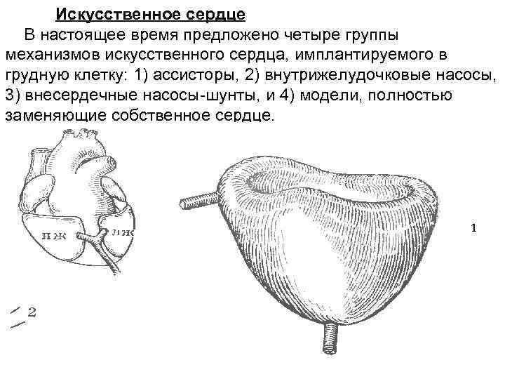 Искусственное сердце В настоящее время предложено четыре группы механизмов искусственного сердца, имплантируемого в грудную