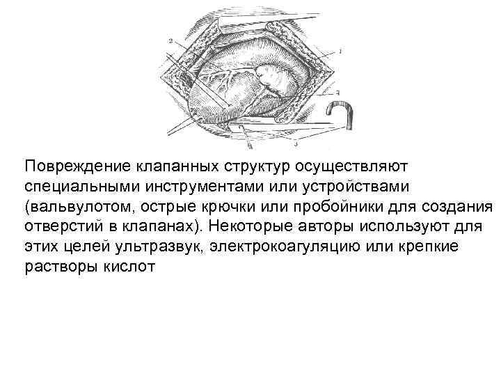 Повреждение клапанных структур осуществляют специальными инструментами или устройствами (вальвулотом, острые крючки или пробойники для