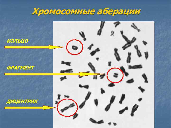 Хромосомные аберации КОЛЬЦО ФРАГМЕНТ ДИЦЕНТРИК 