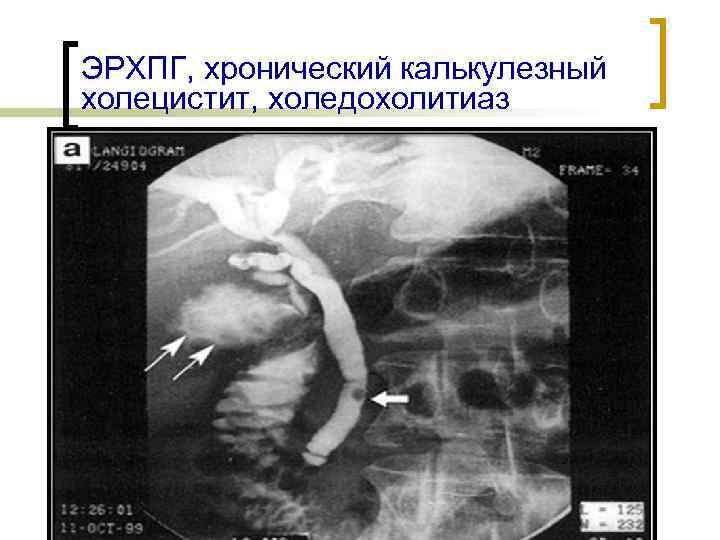 ЭРХПГ, хронический калькулезный холецистит, холедохолитиаз 