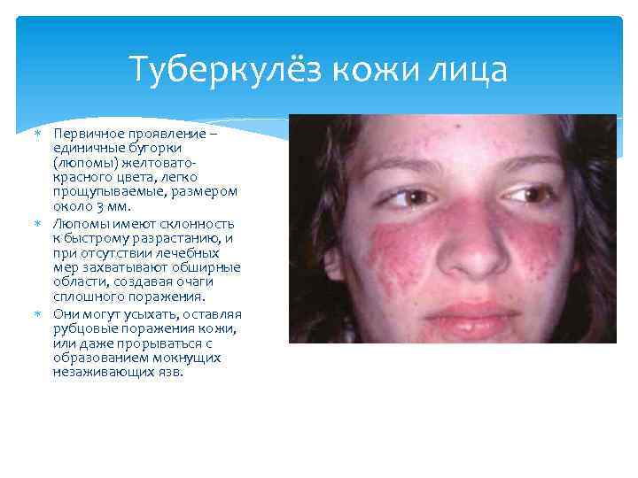 Туберкулёз кожи лица Первичное проявление – единичные бугорки (люпомы) желтоватокрасного цвета, легко прощупываемые, размером