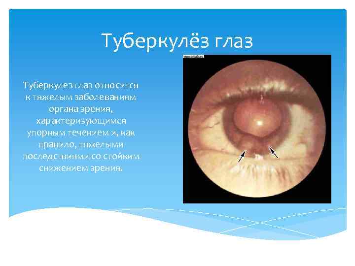 Туберкулёз глаз Туберкулез глаз относится к тяжелым заболеваниям органа зрения, характеризующимся упорным течением и,