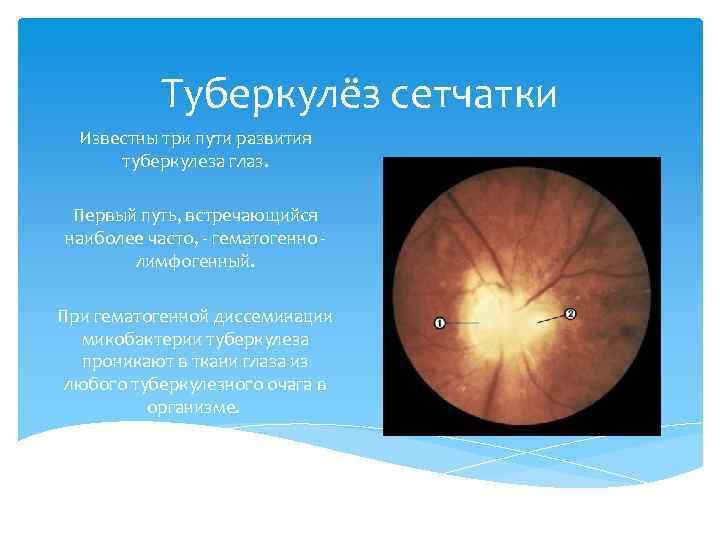 Туберкулёз сетчатки Известны три пути развития туберкулеза глаз. Первый путь, встречающийся наиболее часто, -