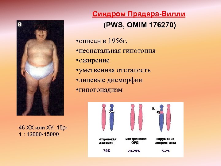 Синдром Прадера-Вилли (PWS, OMIM 176270) • описан в 1956 г. • неонатальная гипотония •