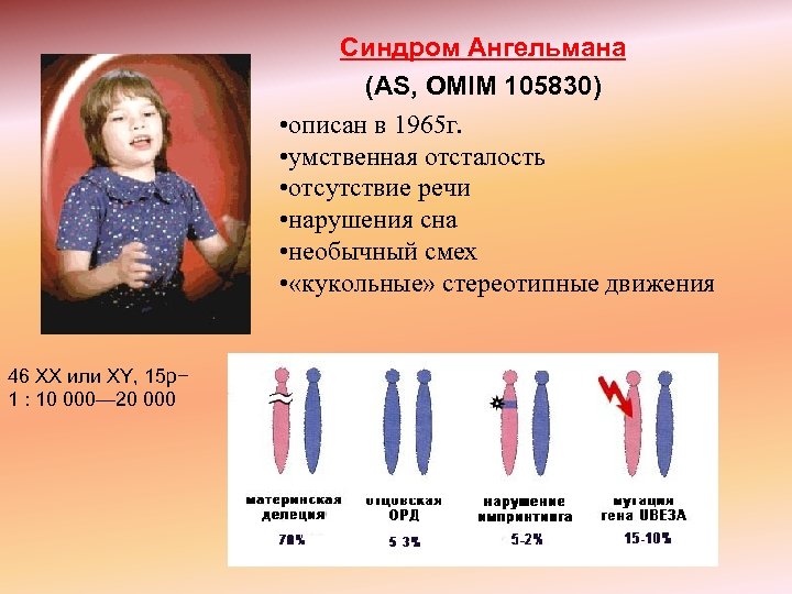 Синдром Ангельмана (AS, OMIM 105830) • описан в 1965 г. • умственная отсталость •