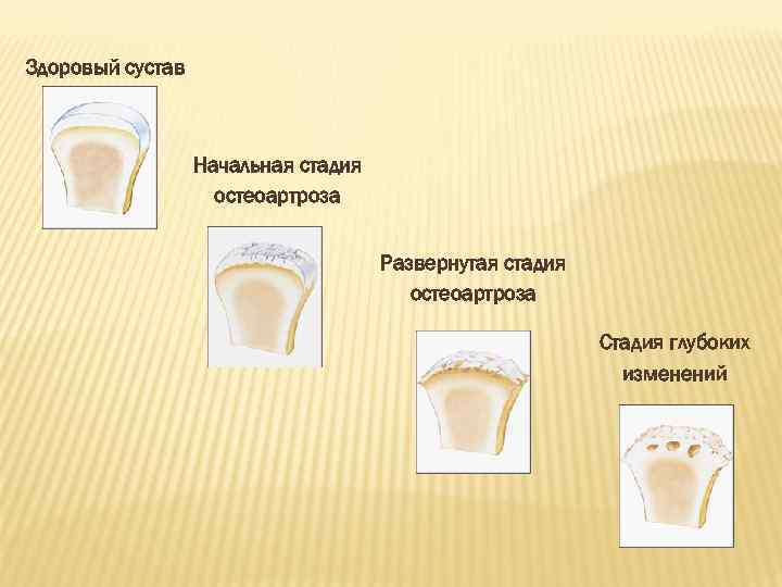 Здоровый сустав Начальная стадия остеоартроза Развернутая стадия остеоартроза Стадия глубоких изменений 