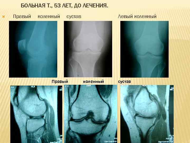 БОЛЬНАЯ Т. , 53 ЛЕТ, ДО ЛЕЧЕНИЯ. Правый сустав коленный сустав Правый Левый коленный