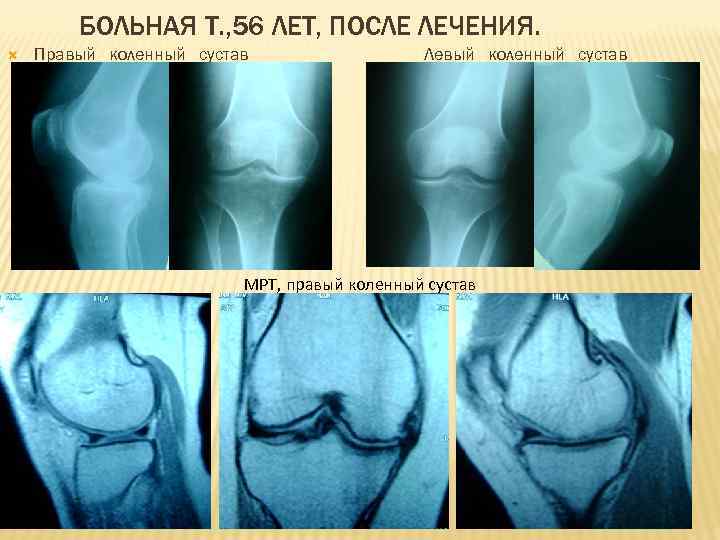 БОЛЬНАЯ Т. , 56 ЛЕТ, ПОСЛЕ ЛЕЧЕНИЯ. Правый коленный сустав Левый коленный сустав МРТ,