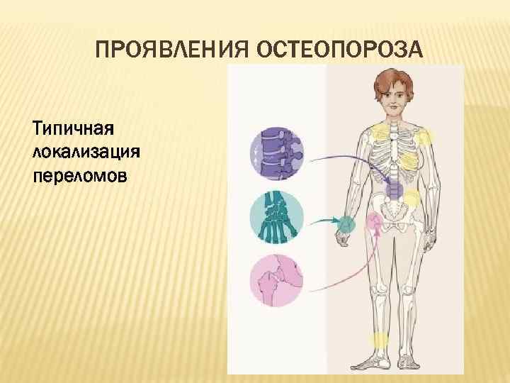 ПРОЯВЛЕНИЯ ОСТЕОПОРОЗА Типичная локализация переломов 