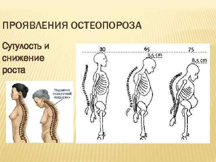 ПРОЯВЛЕНИЯ ОСТЕОПОРОЗА Сутулость и снижение роста 