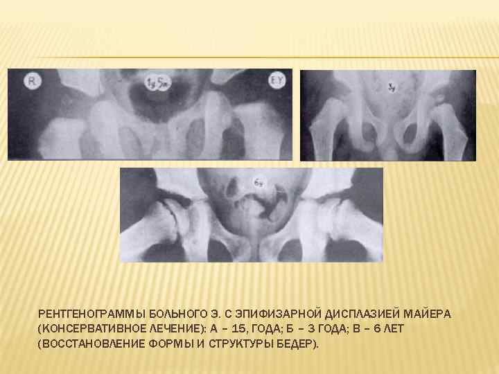 РЕНТГЕНОГРАММЫ БОЛЬНОГО Э. С ЭПИФИЗАРНОЙ ДИСПЛАЗИЕЙ МАЙЕРА (КОНСЕРВАТИВНОЕ ЛЕЧЕНИЕ): А – 15, ГОДА; Б