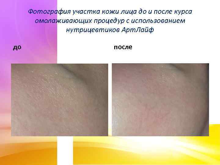 Фотография участка кожи лица до и после курса омолаживающих процедур с использованием нутрицевтиков Арт.
