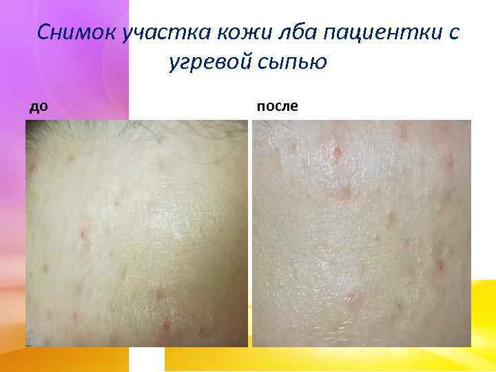 Снимок участка кожи лба пациентки с угревой сыпью до после 