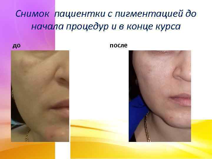 Снимок пациентки с пигментацией до начала процедур и в конце курса до после 
