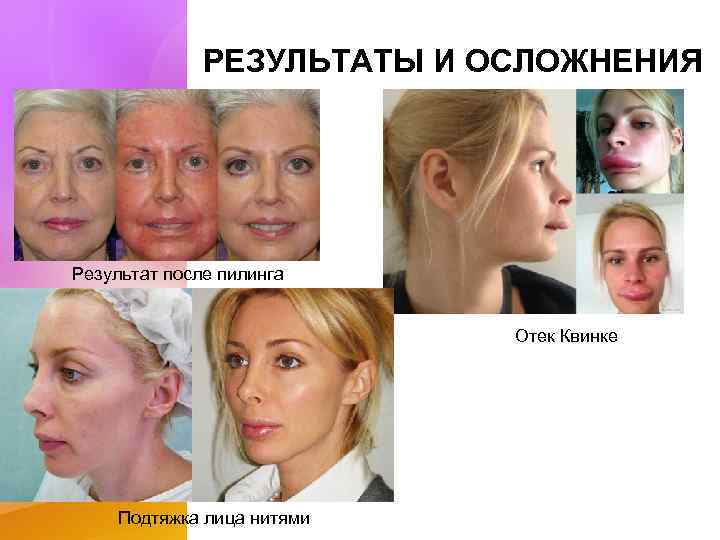 РЕЗУЛЬТАТЫ И ОСЛОЖНЕНИЯ Результат после пилинга Отек Квинке Подтяжка лица нитями 