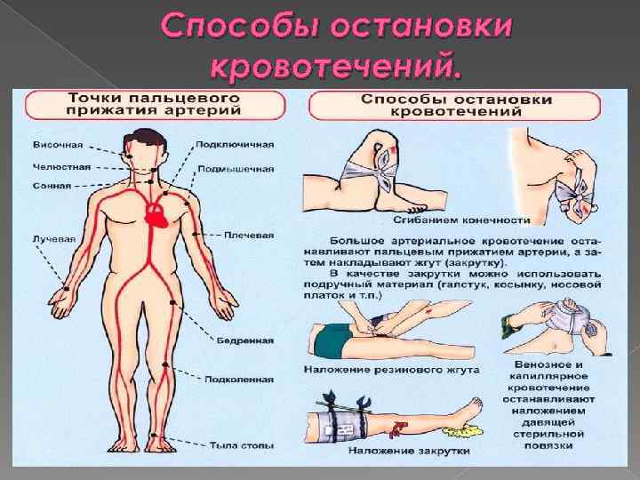 Способы остановки кровотечений. 