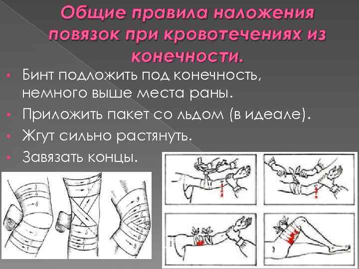 Правила наложения. При наложении повязки бинтование осуществляют. При наложении повязки на конечность следует:. Правила наложения повязки на конечность. При наложении повязки на конечность, бинтование осуществляют:.