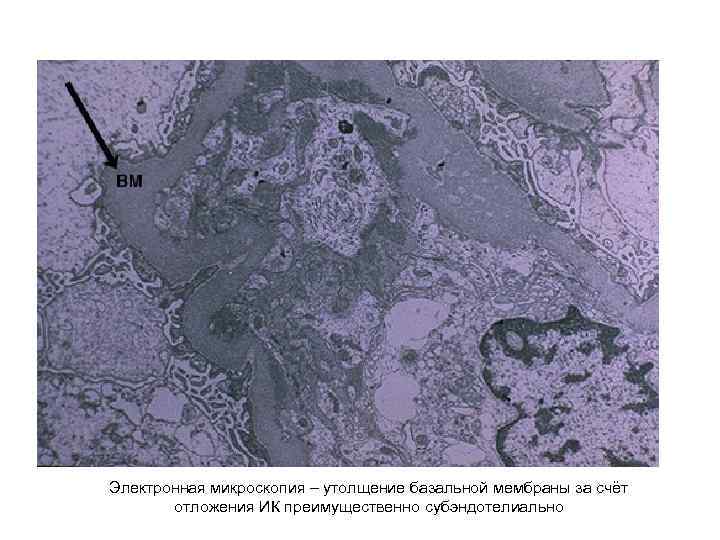 Электронная микроскопия – утолщение базальной мембраны за счёт отложения ИК преимущественно субэндотелиально 